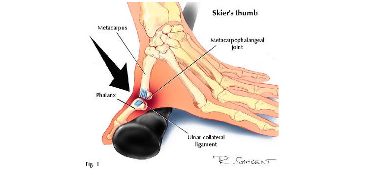 Skier's Thumb Symptoms