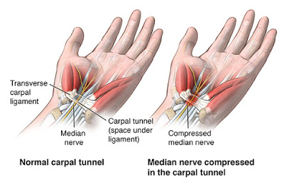 carpal tunnel syndrome surgery