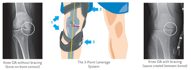 Best Unloader Knee Brace for Osteoarthritis