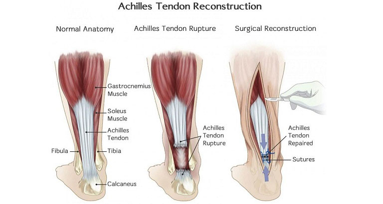 tendon release surgery recovery time