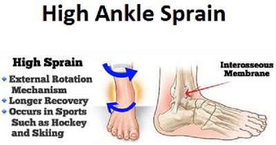 High Ankle Sprain Recovery Time
