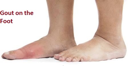 Gout on the Foot