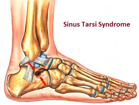 Sinus Tarsi Syndrome