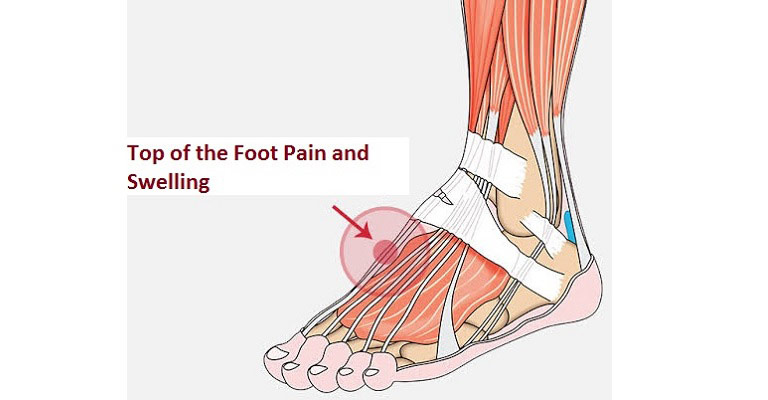 Top of the Foot Pain and Swelling