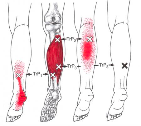 Trigger Point Plantar Fasciitis