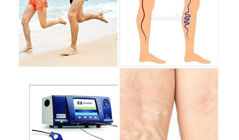 Treatment for Varicose Veins