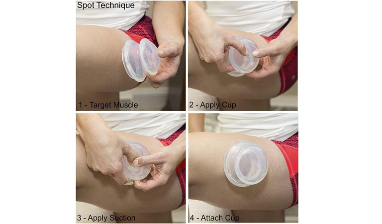 Cupping For Cellulite