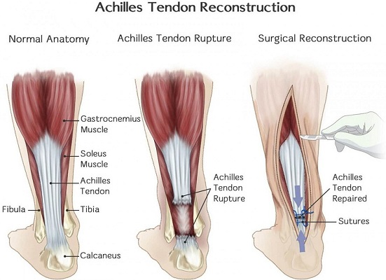Achilles Tendon Rupture Recovery Time
