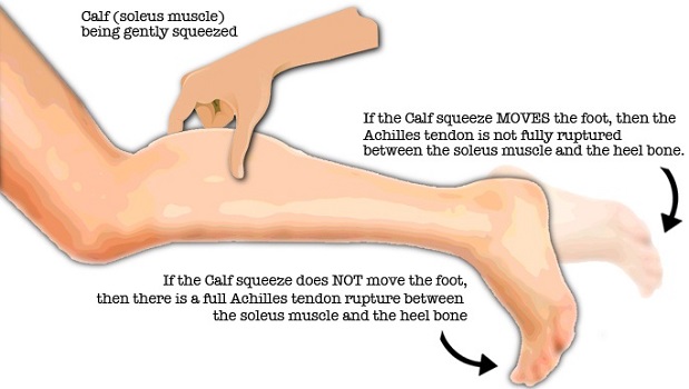 Ruptured Achilles Tendon Test