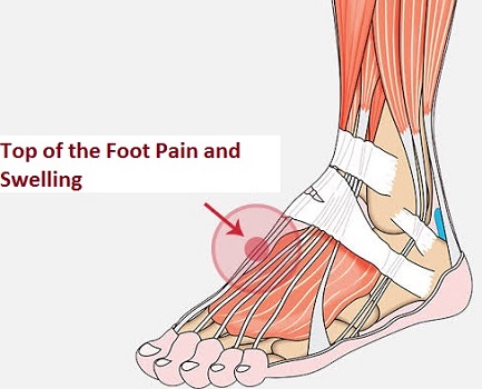 Top of the Foot Pain and Swelling