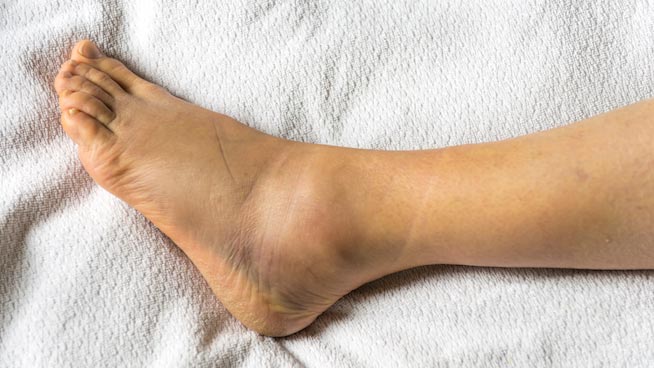 Ankle Sprain Symptoms
