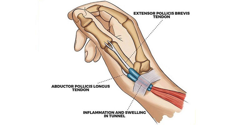 De Quervain's Tenosynovitis