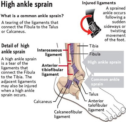High Ankle Sprain