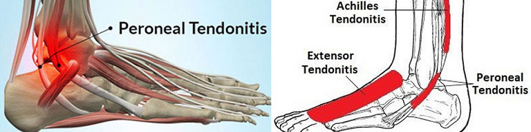 Peroneal-Tendonitis