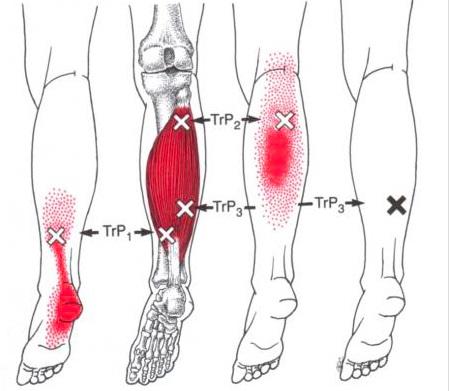 Trigger Point Plantar Fasciitis